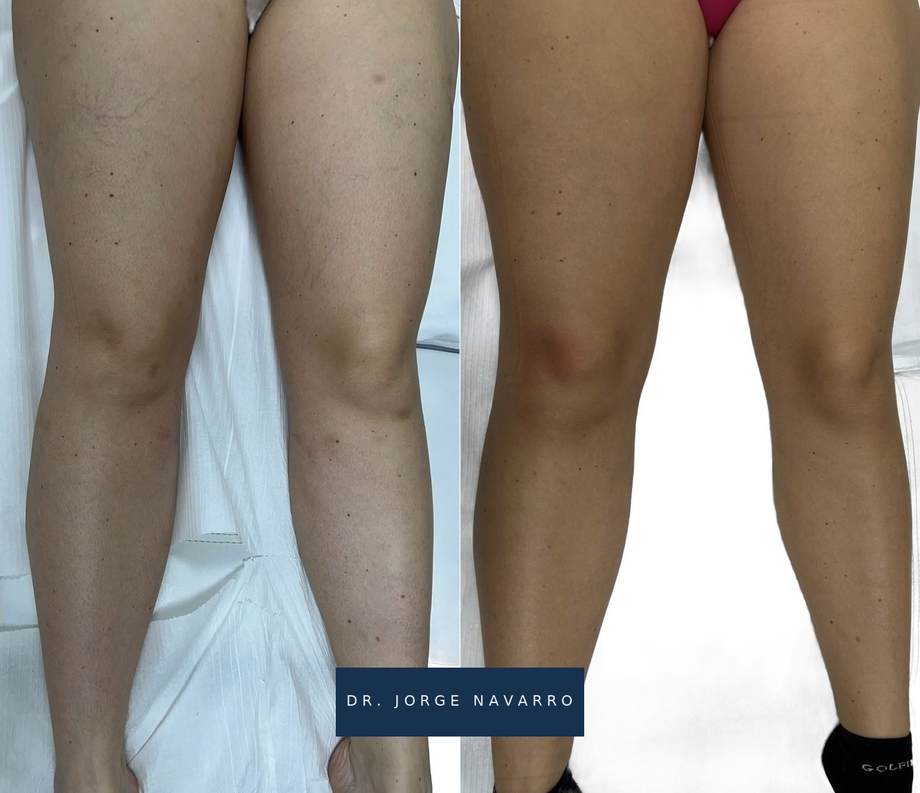 Laser Varizes — antes e depois (caso 1)