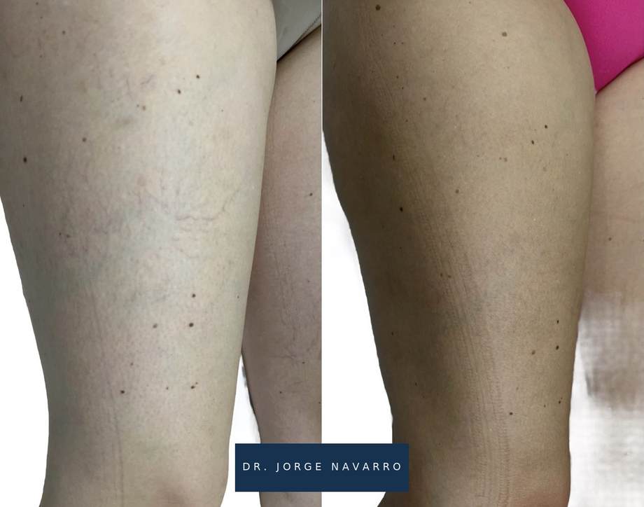 Laser Varizes — antes e depois (caso 2)
