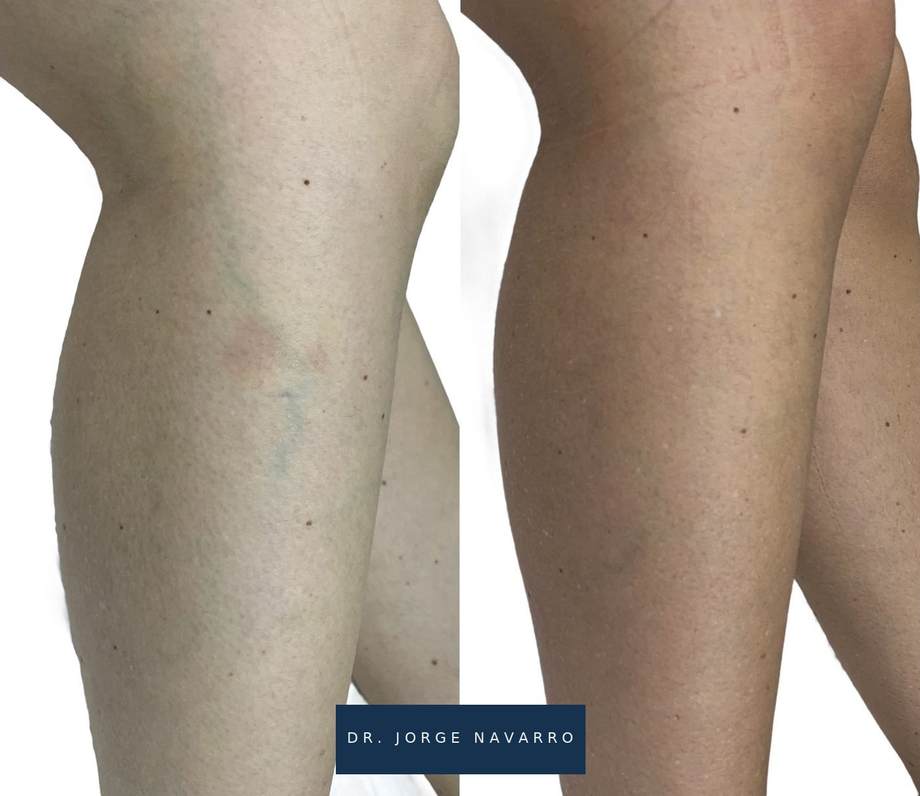 Laser Varizes — antes e depois (caso 3)