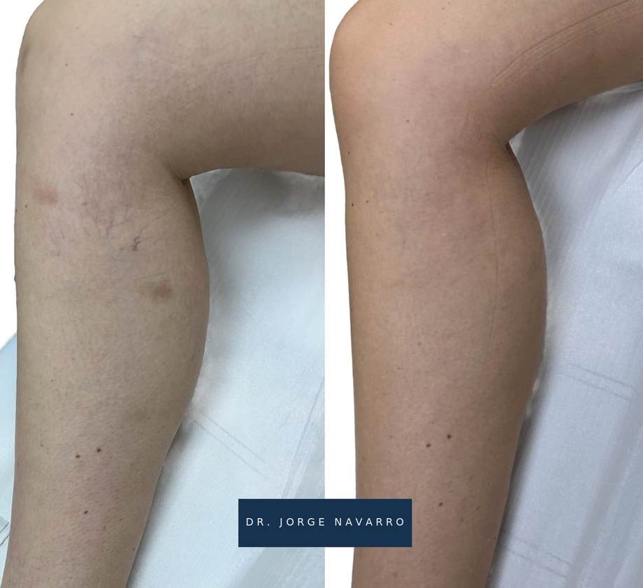 Laser Varizes — antes e depois (caso 4)