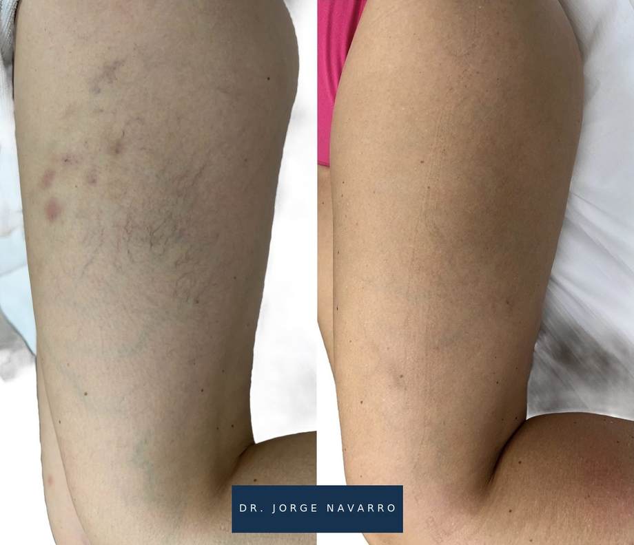Laser Varizes — antes e depois (caso 5)