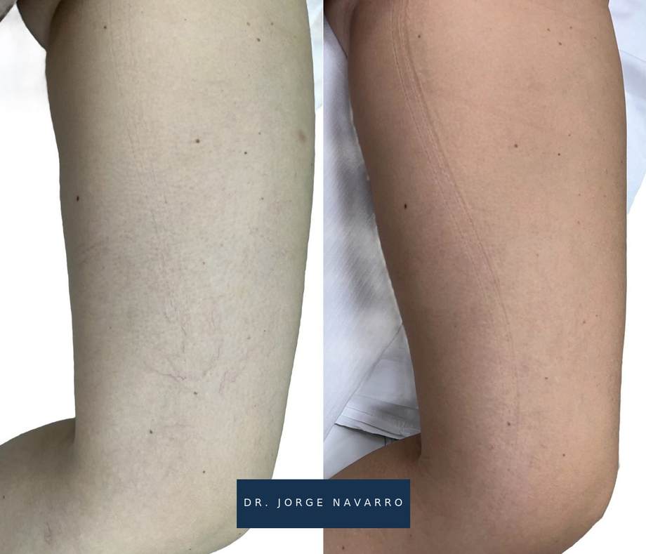 Laser Varizes — antes e depois (caso 6)