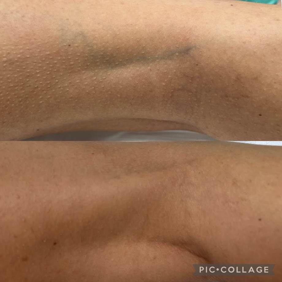 Laser Varizes — antes e depois (caso 7)