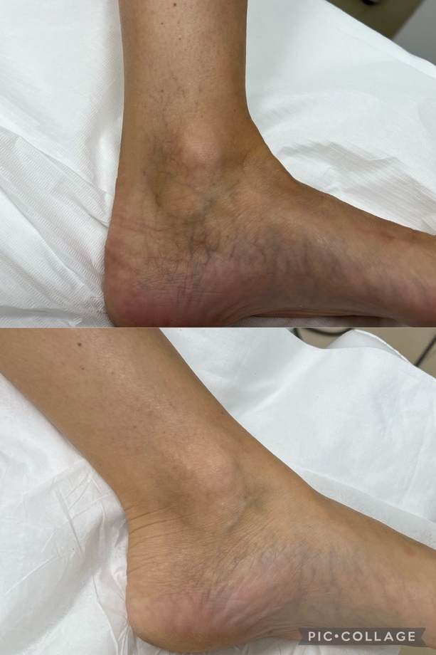 Laser Varizes — antes e depois (caso 8)