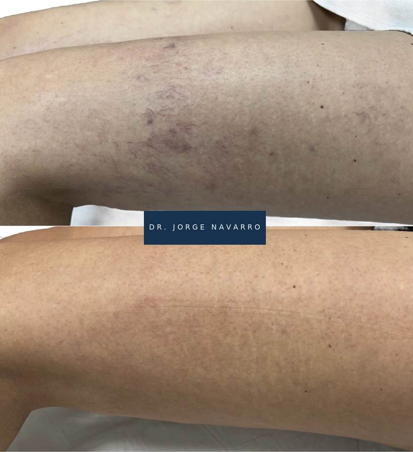 Laser Varizes — antes e depois (caso 9)