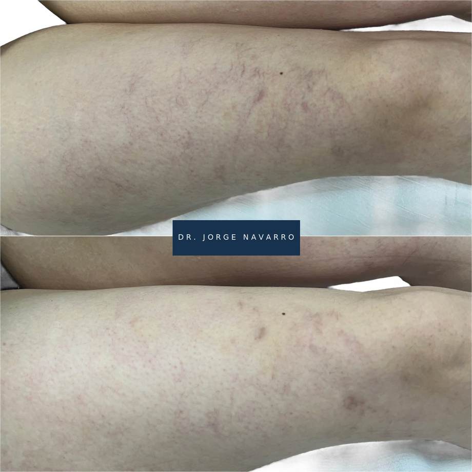 Laser Varizes — antes e depois (caso 10)