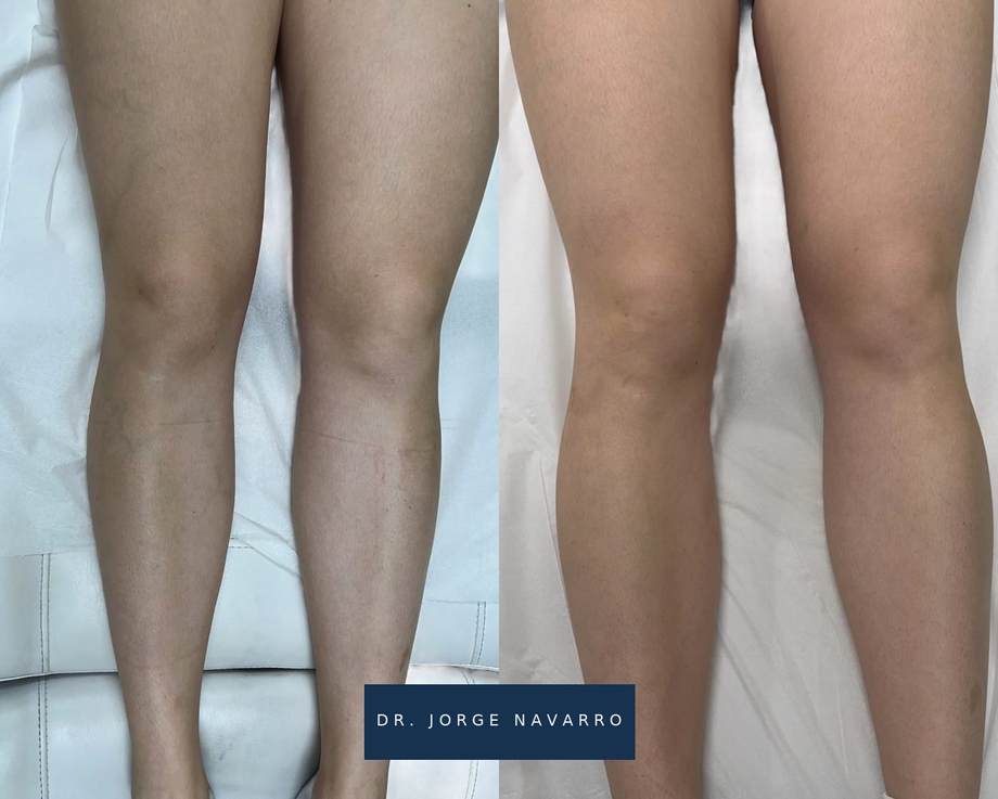 Laser Varizes — antes e depois (caso 11)