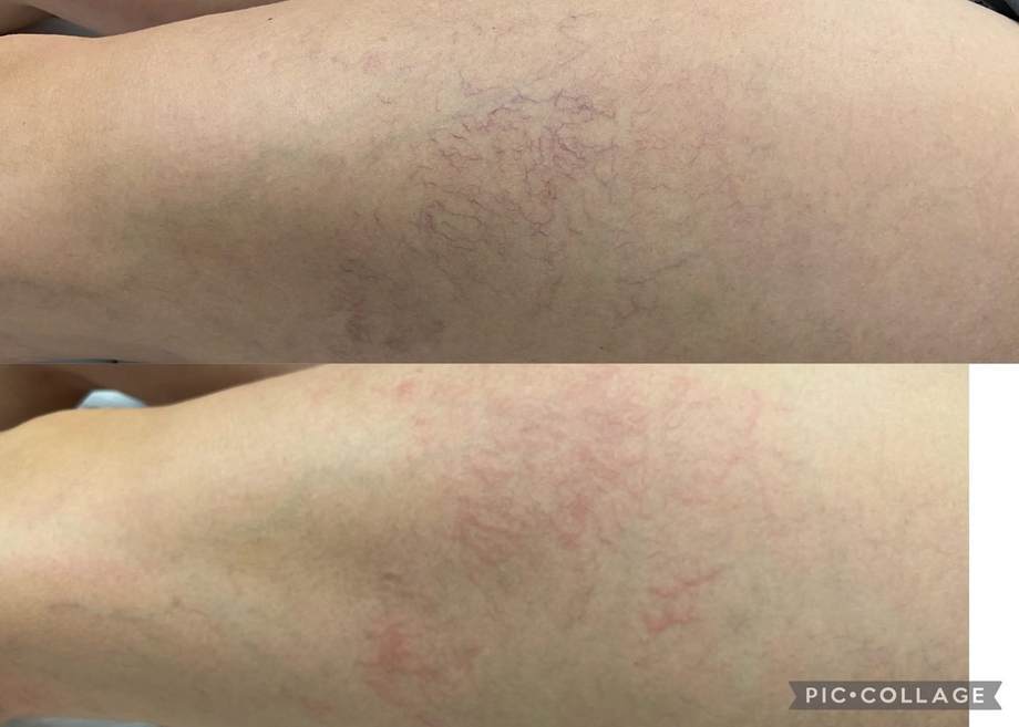 Laser Varizes — antes e depois (caso 12)