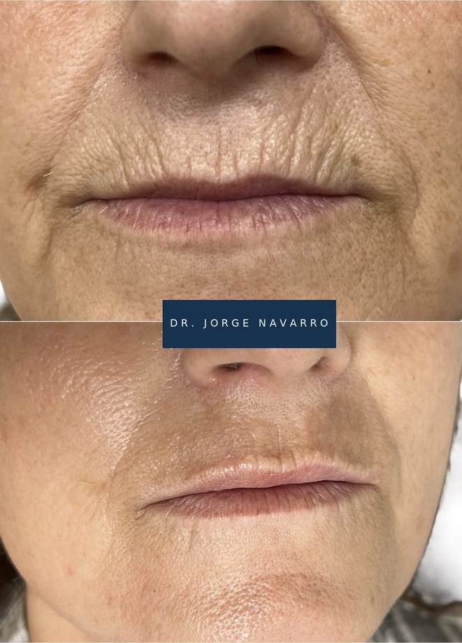 Rejuvenescimento Facial e das Mãos — antes e depois (caso 1)