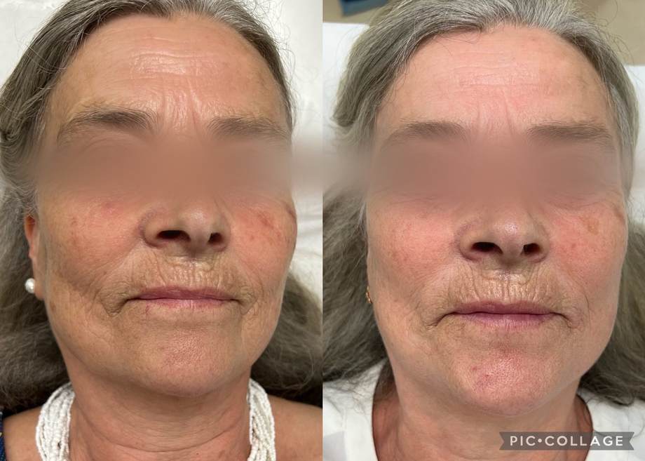 Rejuvenescimento Facial e das Mãos — antes e depois (caso 2)