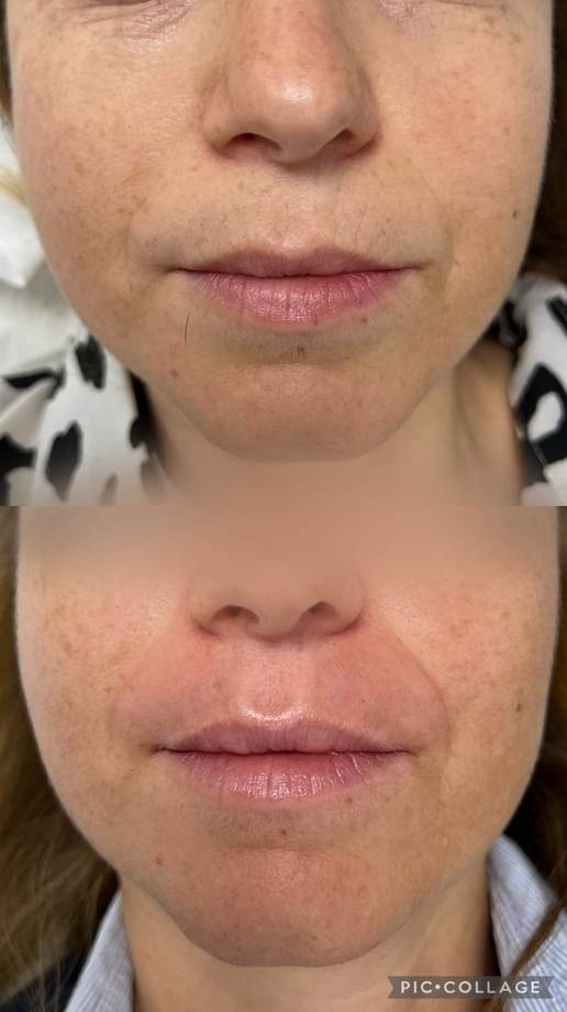 Rejuvenescimento Facial e das Mãos — antes e depois (caso 3)