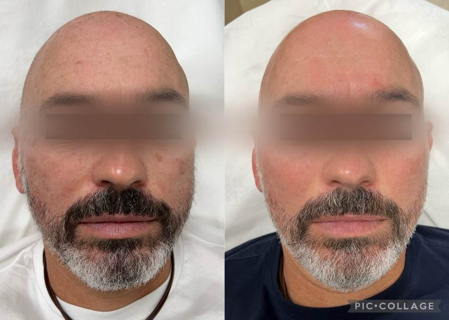 Rejuvenescimento Facial e das Mãos — antes e depois (caso 4)