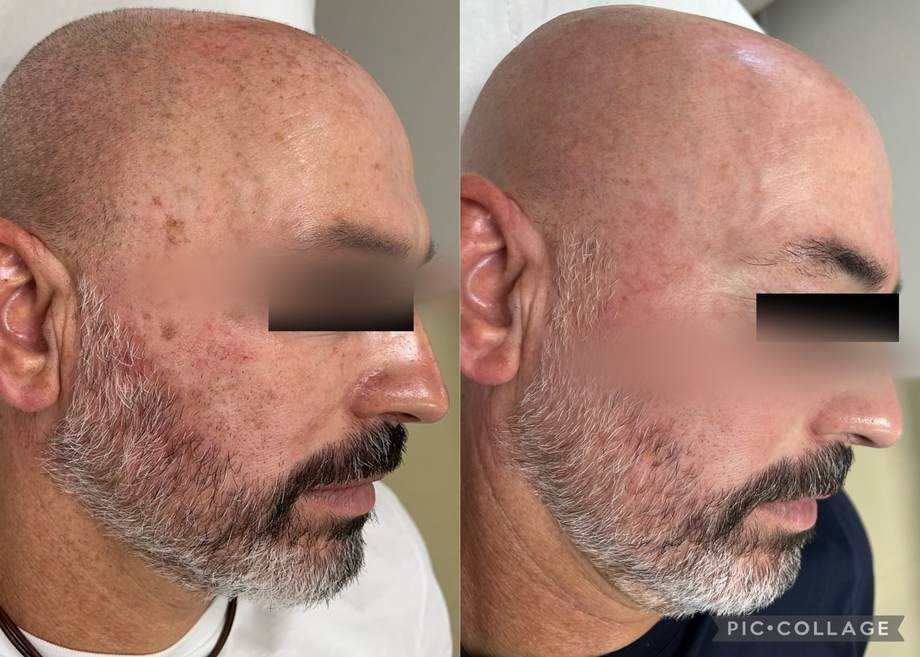 Rejuvenescimento Facial e das Mãos — antes e depois (caso 5)