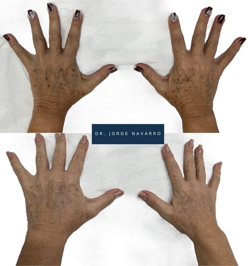 Rejuvenescimento Facial e das Mãos — antes e depois (caso 6)