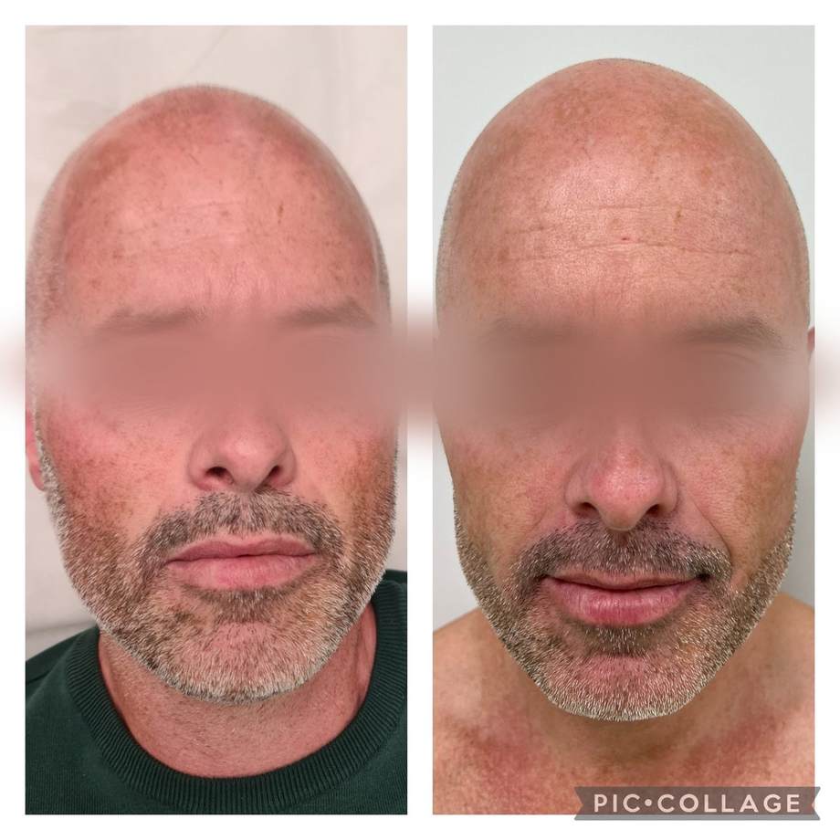 Rejuvenescimento Facial e das Mãos — antes e depois (caso 7)