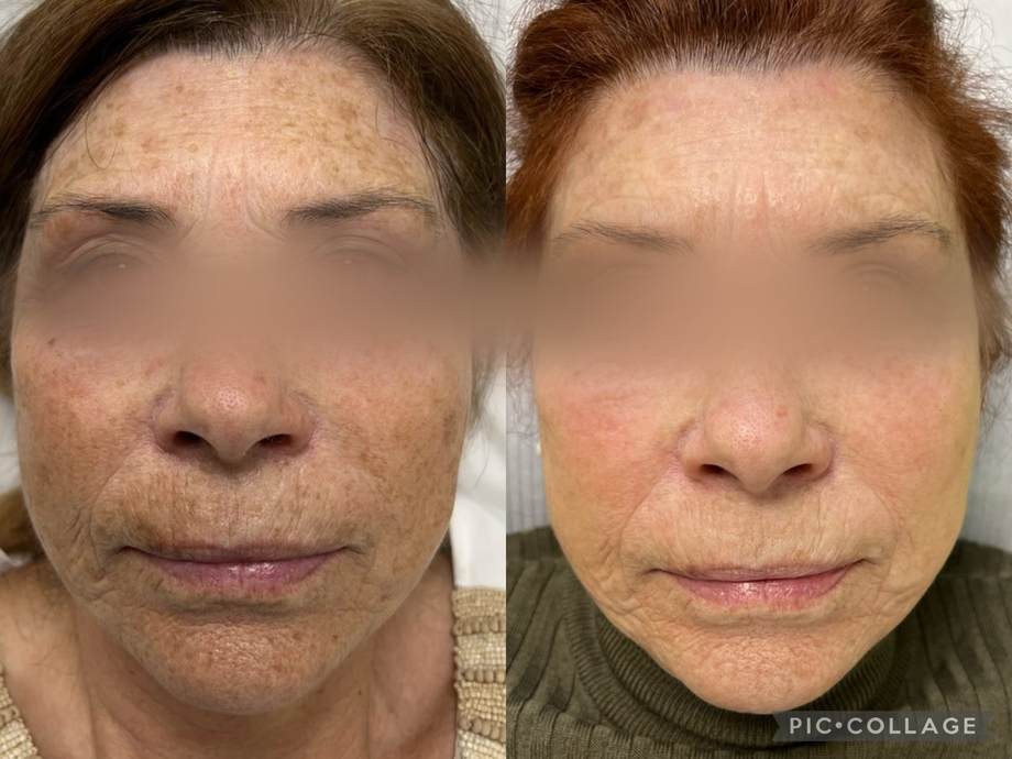 Rejuvenescimento Facial e das Mãos — antes e depois (caso 8)