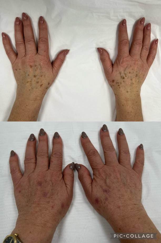 Rejuvenescimento Facial e das Mãos — antes e depois (caso 9)