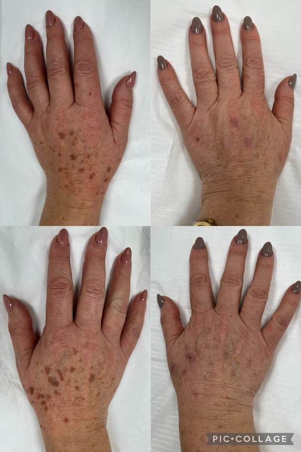 Rejuvenescimento Facial e das Mãos — antes e depois (caso 10)