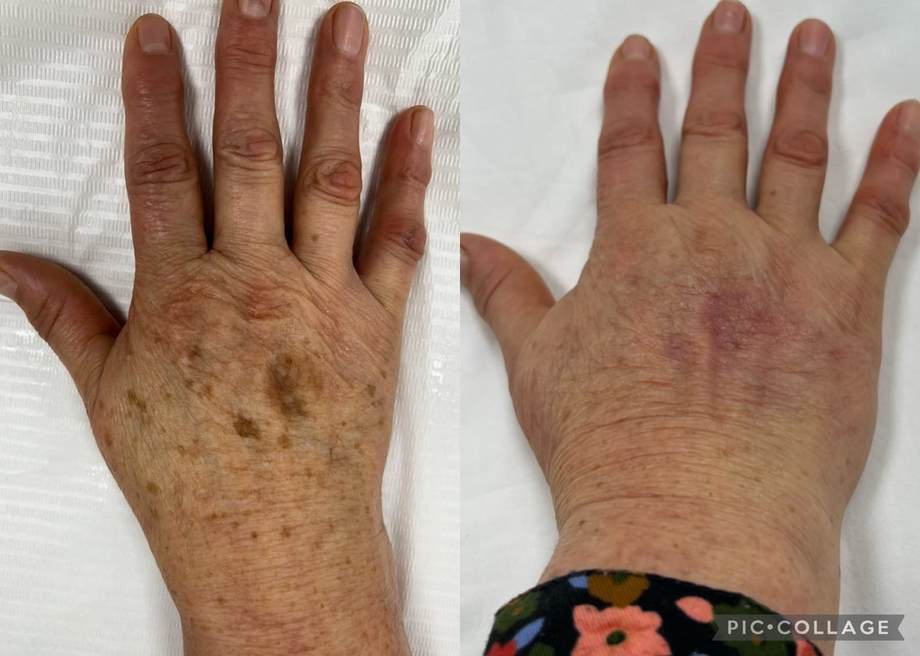 Rejuvenescimento Facial e das Mãos — antes e depois (caso 11)