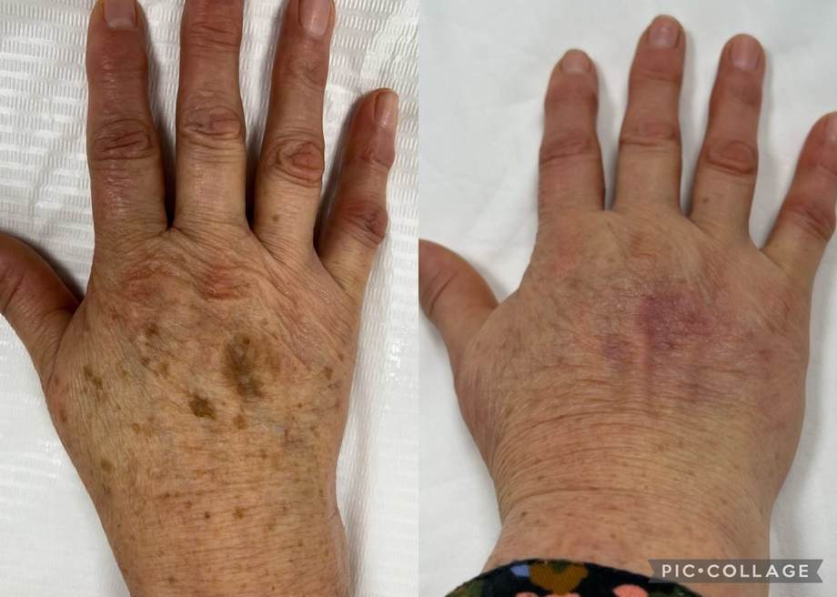 Rejuvenescimento Facial e das Mãos — antes e depois (caso 12)