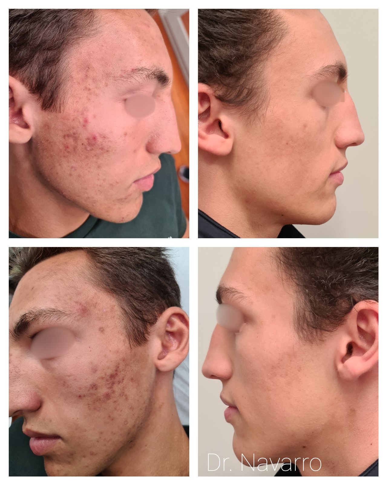 Peeling Químico — antes e depois (caso 1)