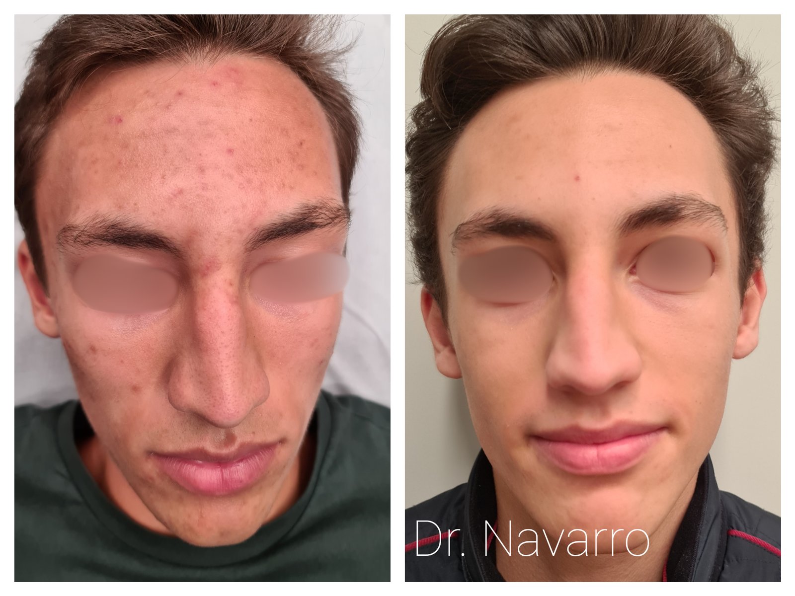 Peeling Químico — antes e depois (caso 2)