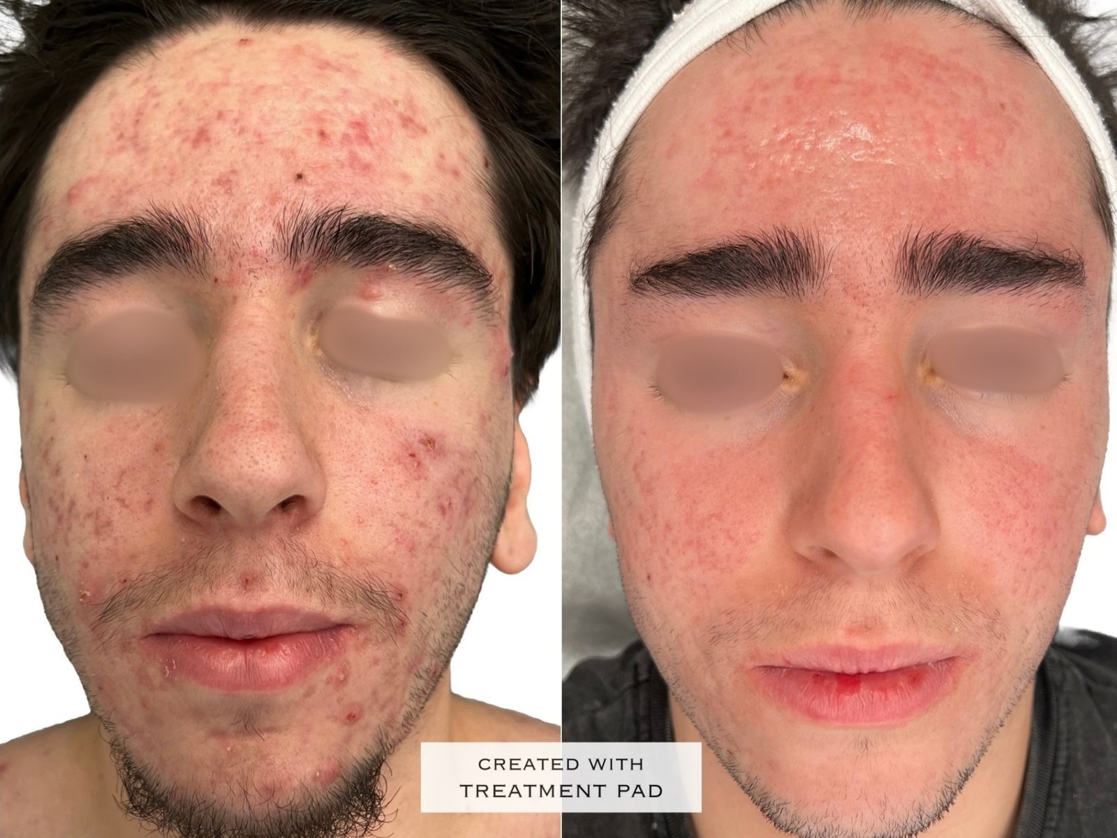 Peeling Químico — antes e depois (caso 3)