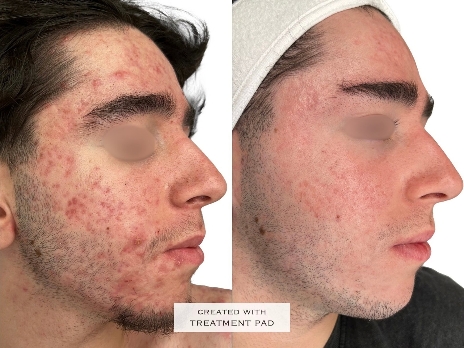 Peeling Químico — antes e depois (caso 4)
