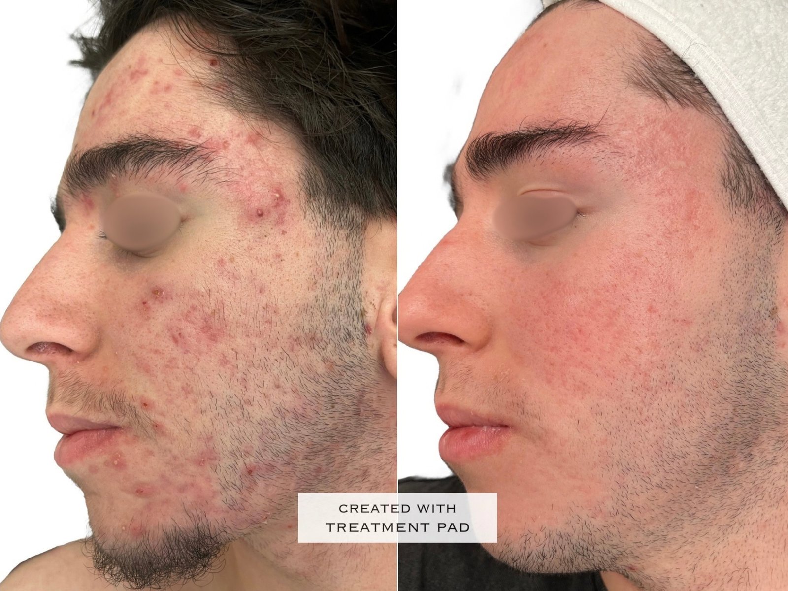 Peeling Químico — antes e depois (caso 5)