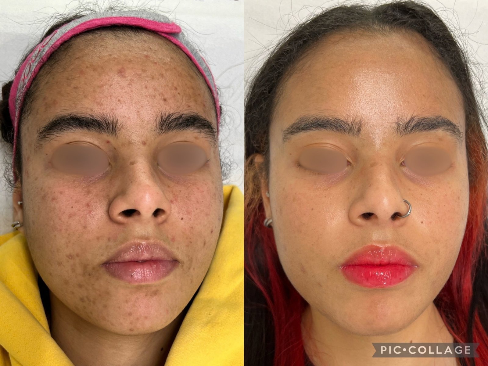 Peeling Químico — antes e depois (caso 6)