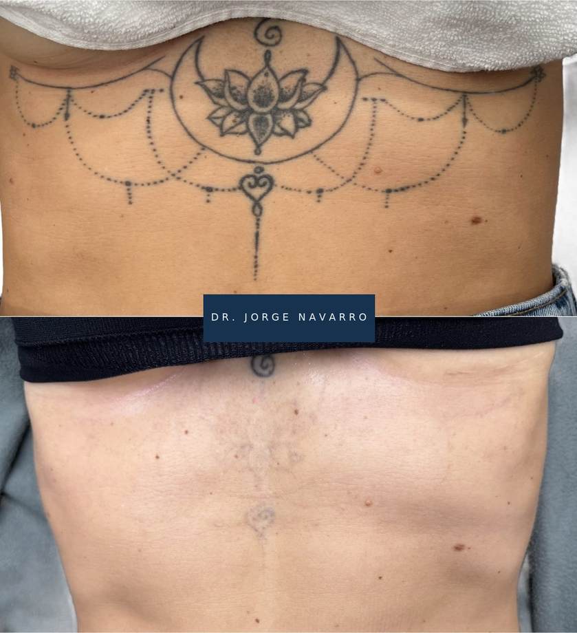 Remoção de Tatuagens — antes e depois (caso 1)