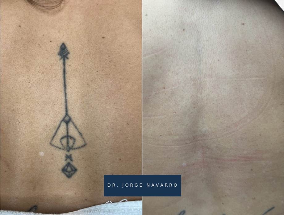 Remoção de Tatuagens — antes e depois (caso 2)