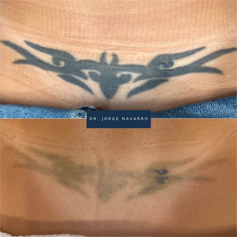 Remoção de Tatuagens — antes e depois (caso 3)