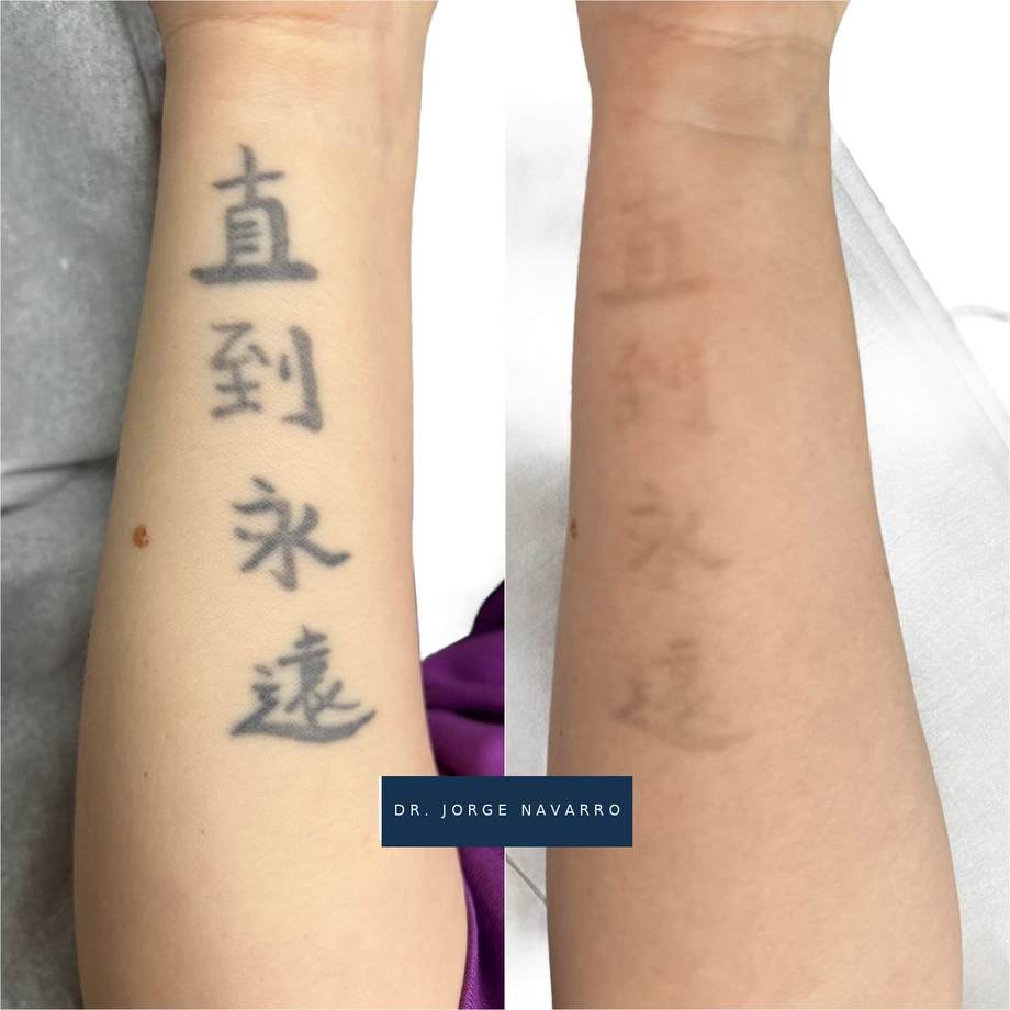 Remoção de Tatuagens — antes e depois (caso 4)