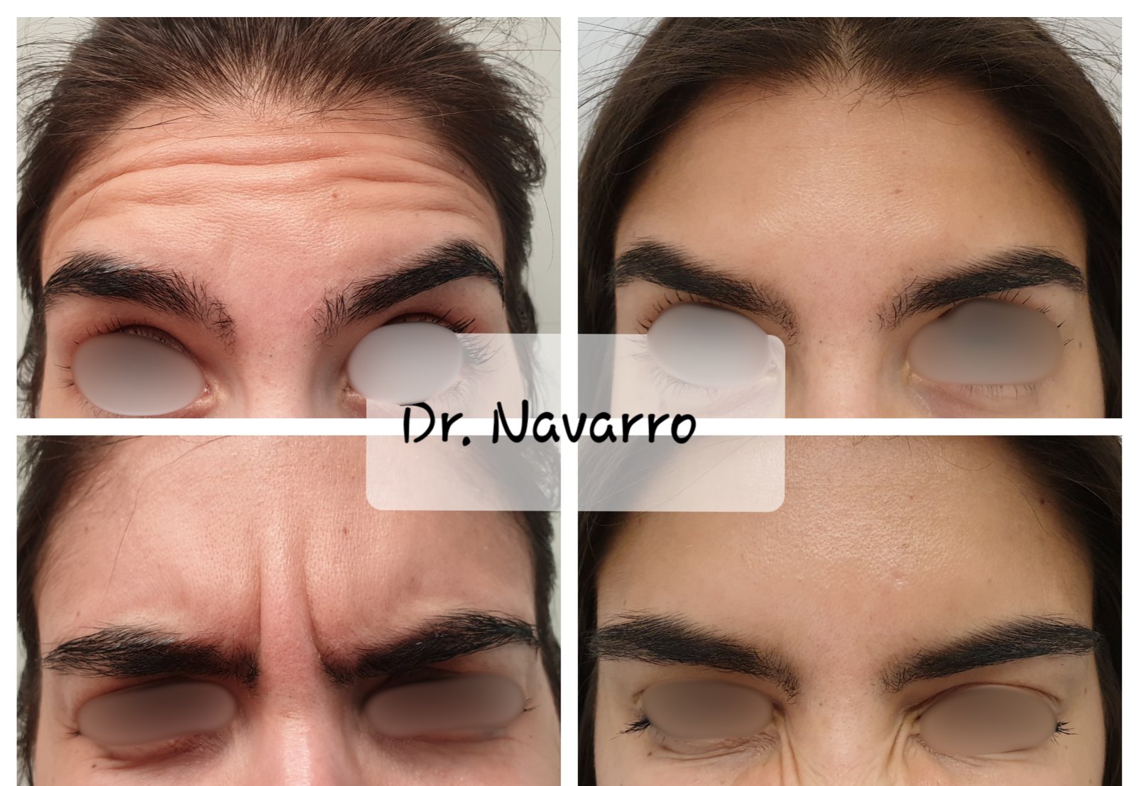 Toxina Botulínica — antes e depois (caso 2)
