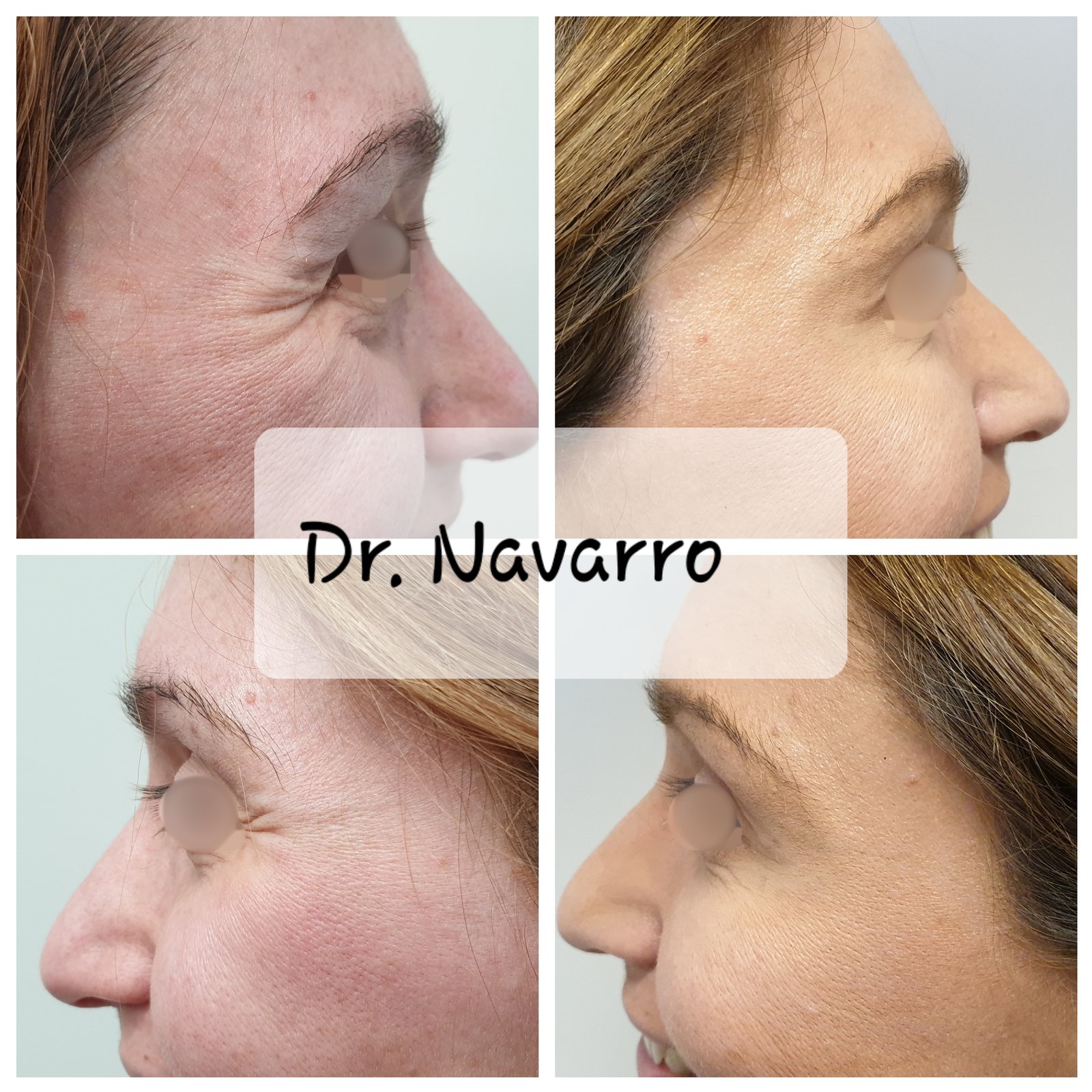 Toxina Botulínica — antes e depois (caso 3)