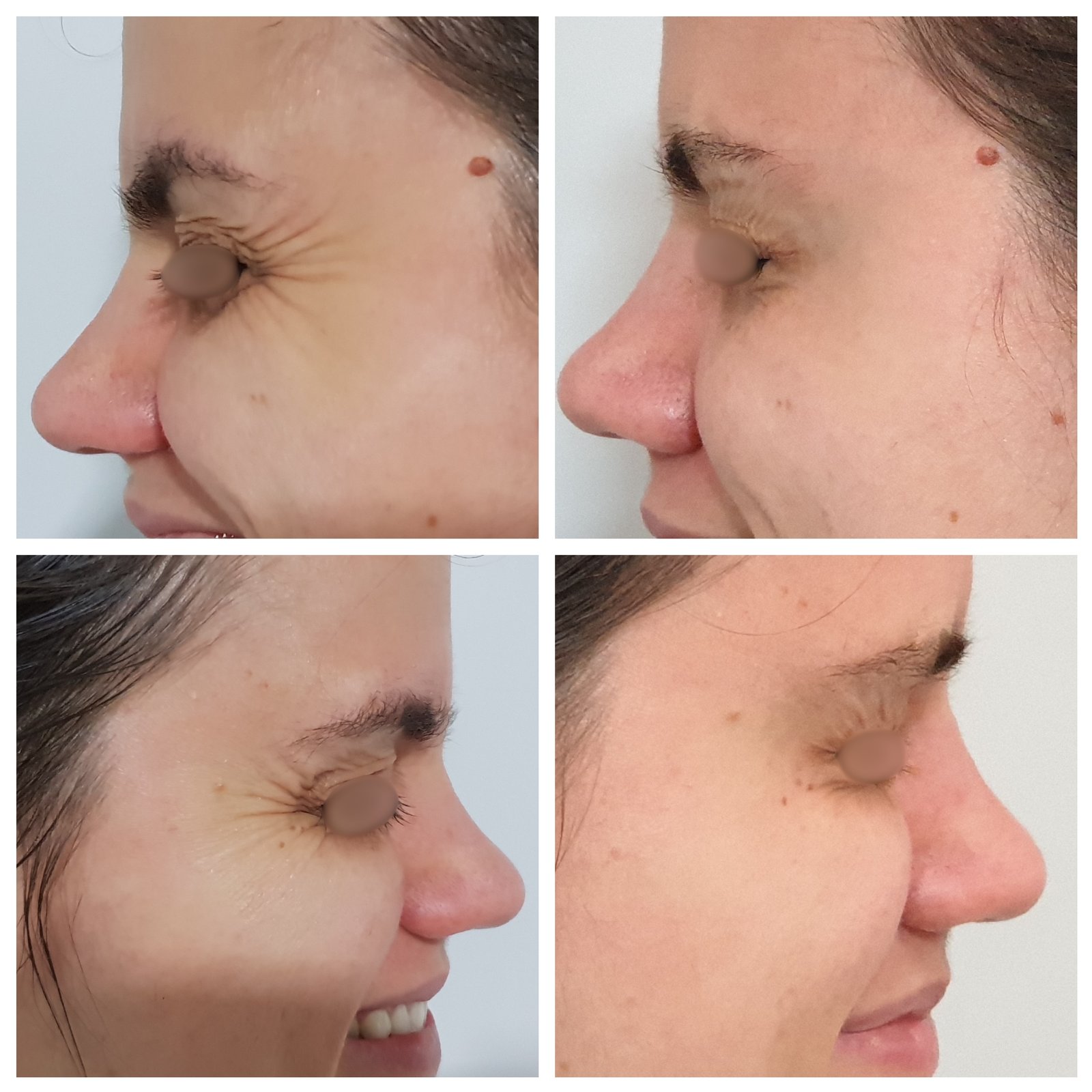 Toxina Botulínica — antes e depois (caso 4)
