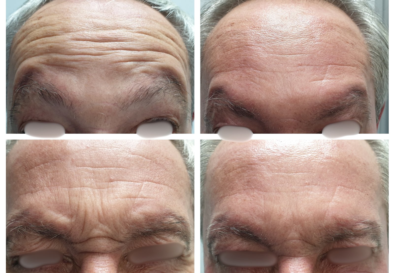 Toxina Botulínica — antes e depois (caso 5)