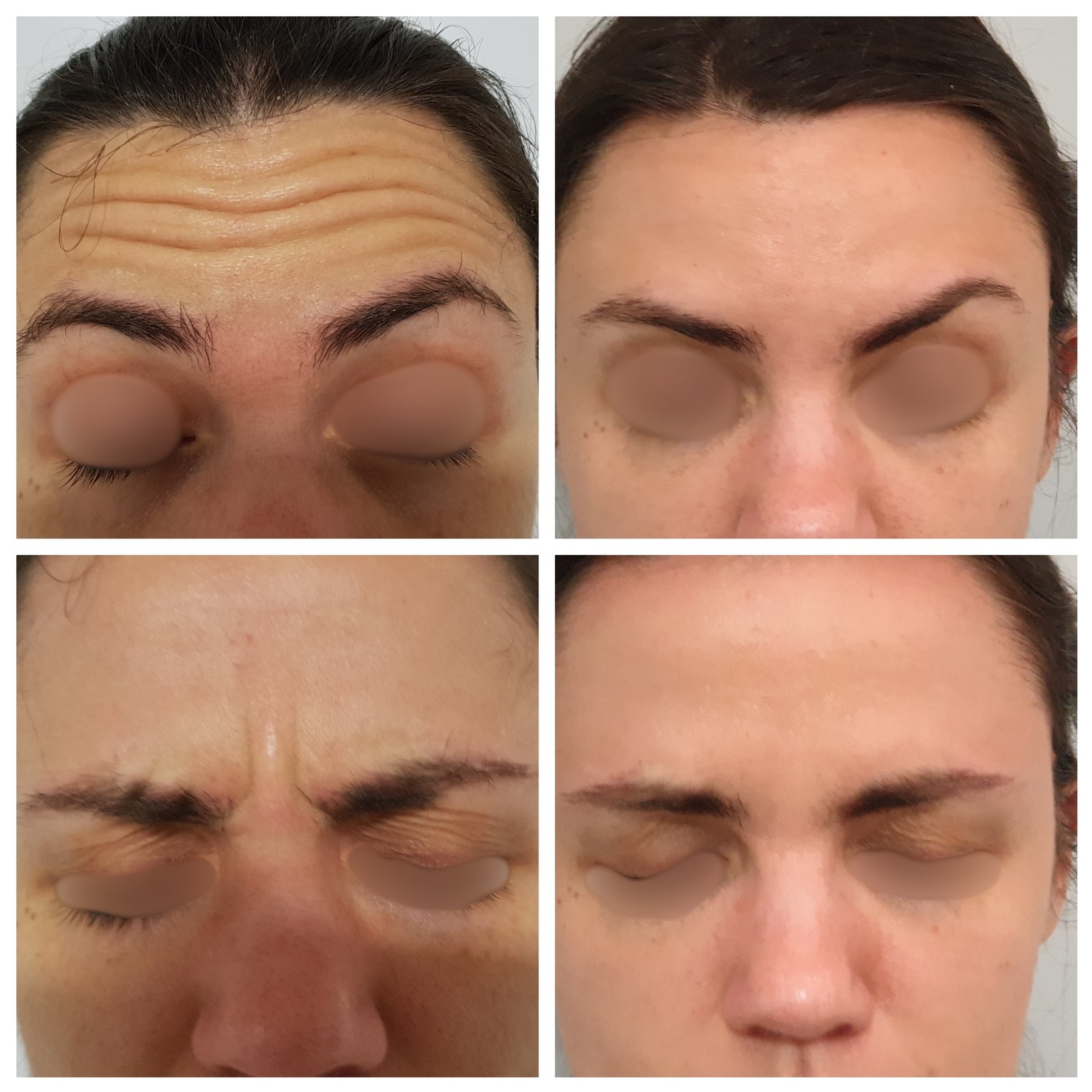 Toxina Botulínica — antes e depois (caso 6)