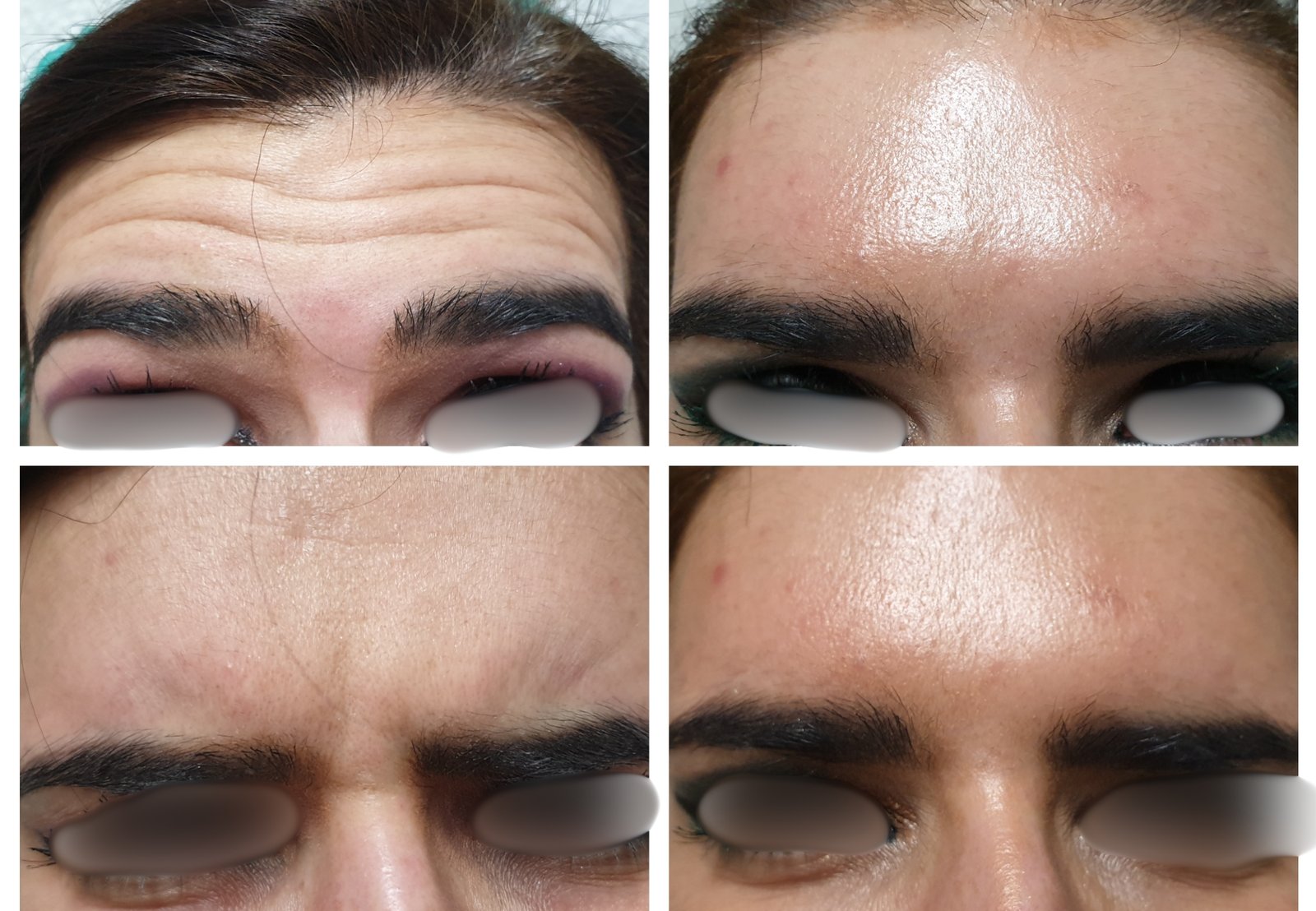 Toxina Botulínica — antes e depois (caso 7)