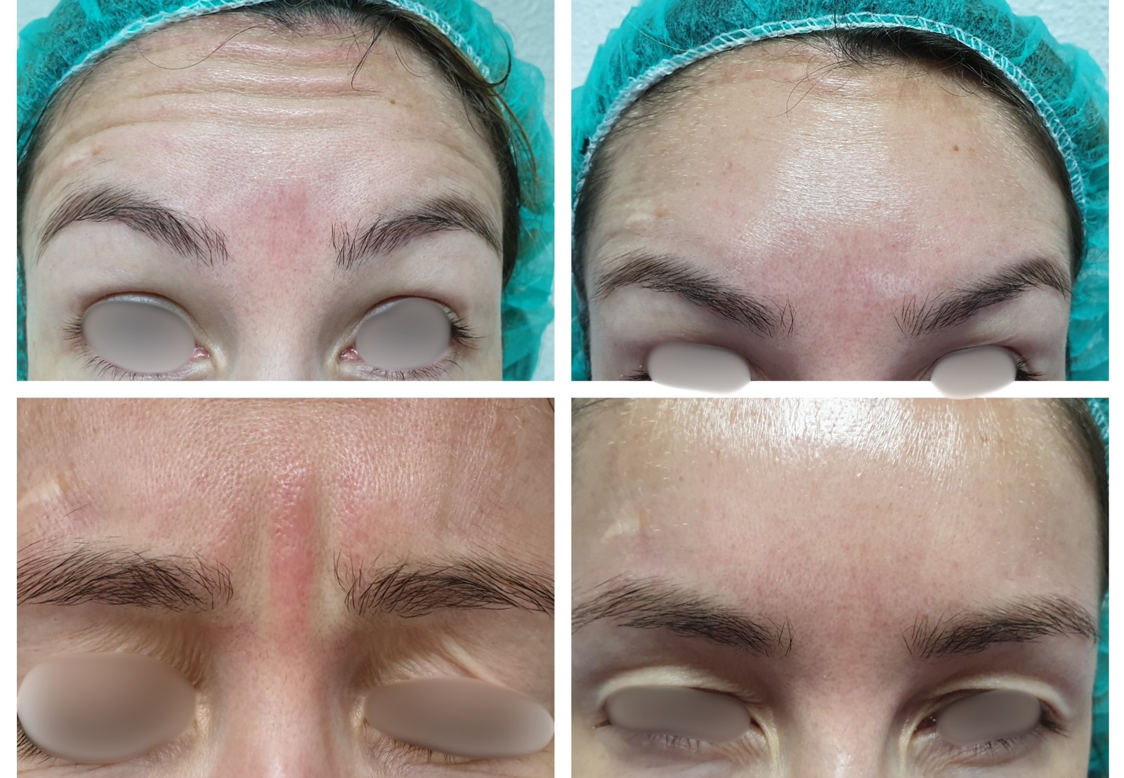 Toxina Botulínica — antes e depois (caso 8)