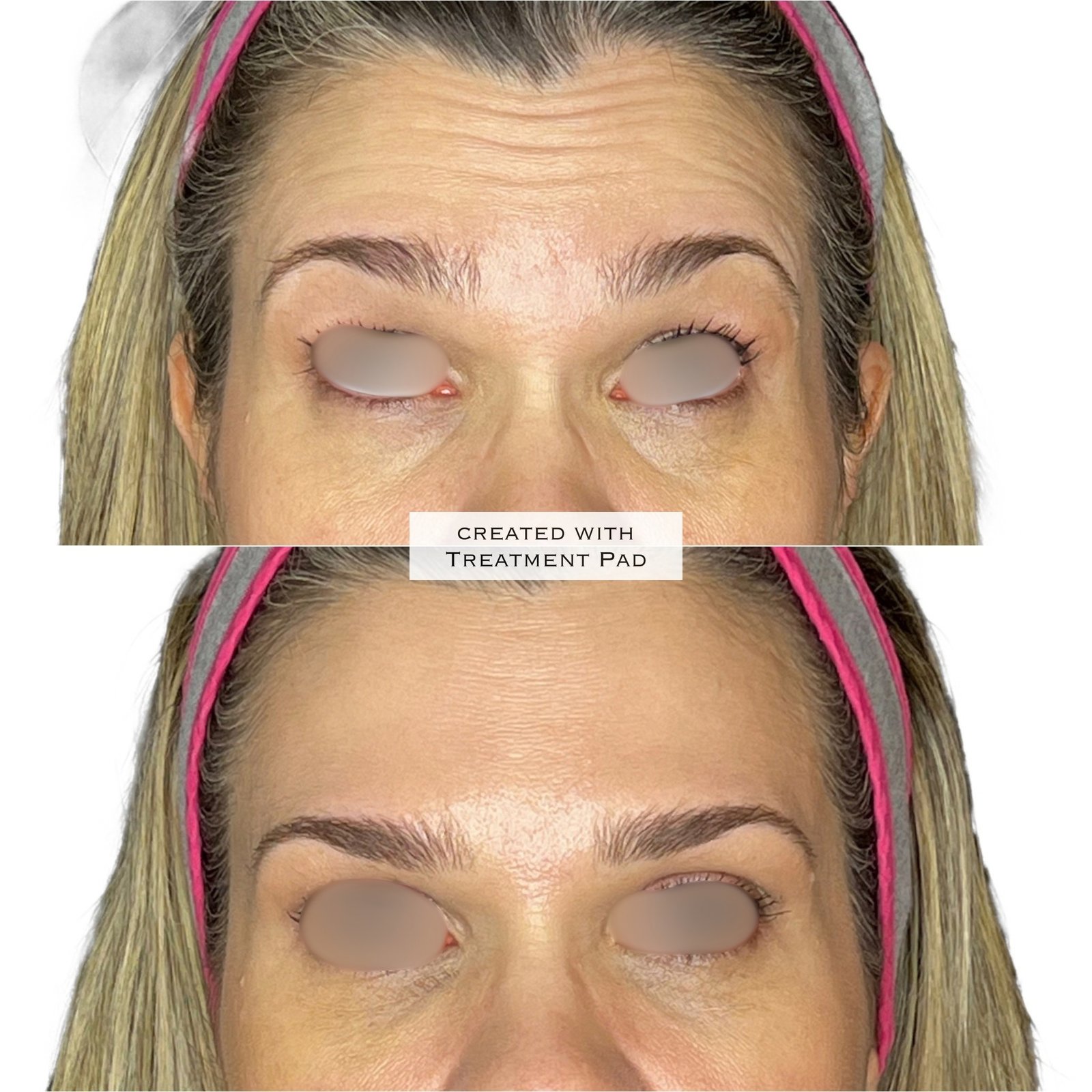 Toxina Botulínica — antes e depois (caso 9)