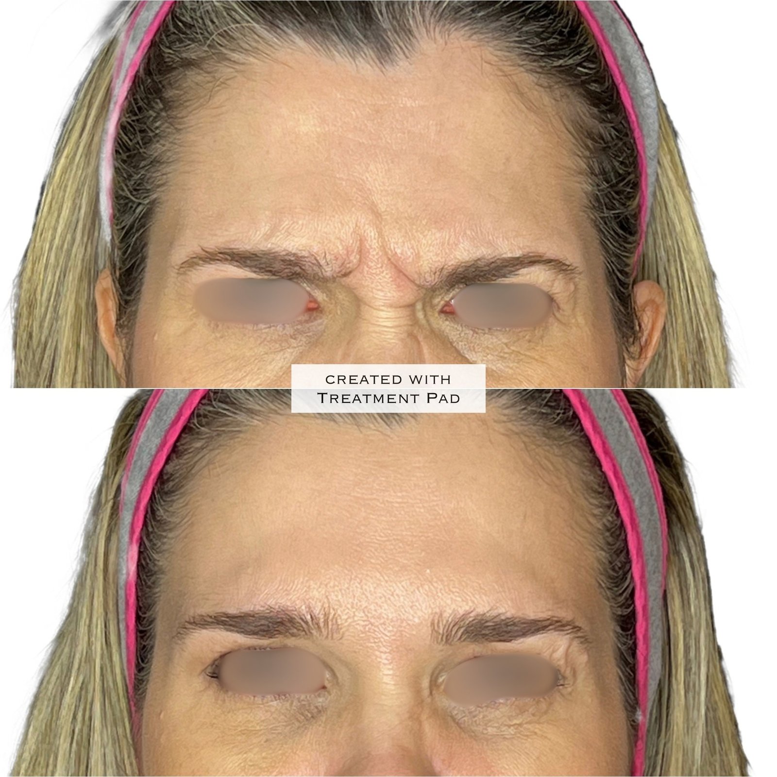 Toxina Botulínica — antes e depois (caso 10)