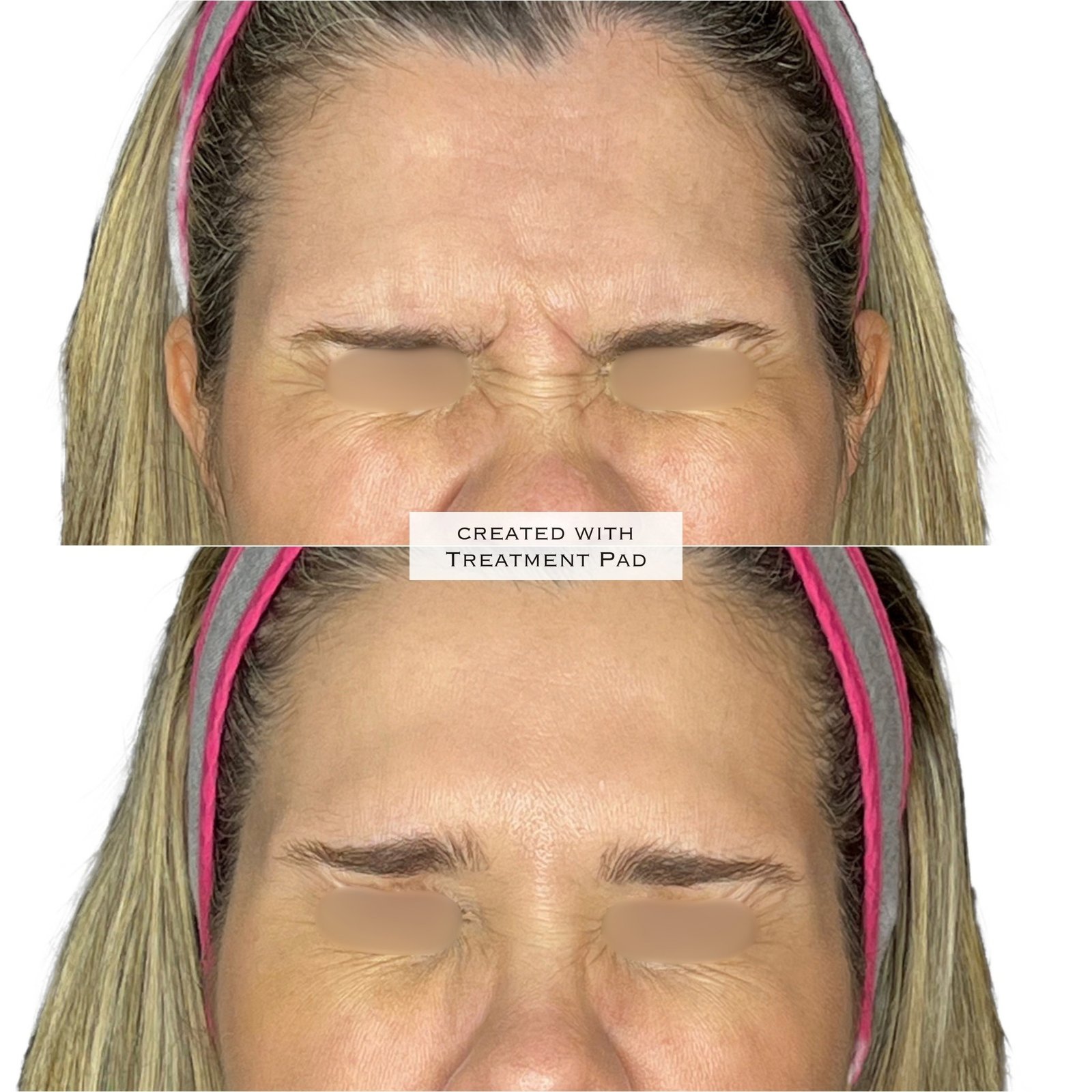 Toxina Botulínica — antes e depois (caso 11)