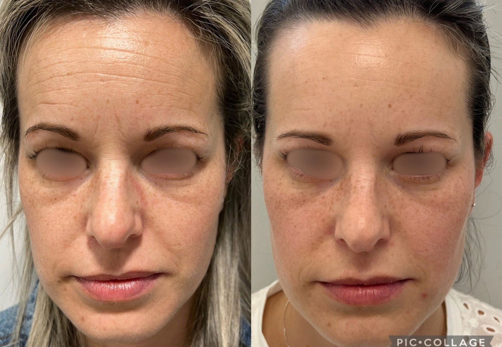 Toxina Botulínica — antes e depois (caso 12)