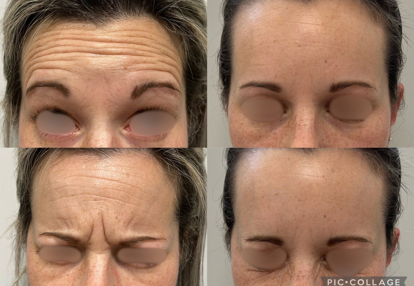 Toxina Botulínica — antes e depois (caso 13)